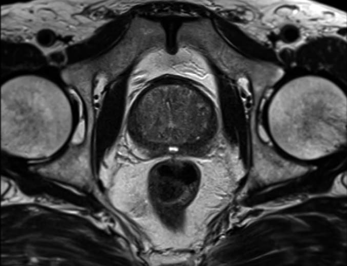 Magnetická rezonance prostaty pro diagnostiku buněk rakoviny prostaty