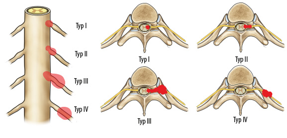 Obr. 1 Klasifikace spinálních schwannomů, typ I–IV. (Podle: Sun I, Pamir MN. Non-syndromic spinal Schwannomas: a novel classification. Front. Neurol. 2017;6)